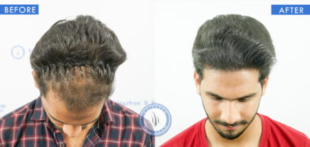 top view of before and after male hair surgery treatment done at best hair transplant clinic in india hairfree and hairgrow clinic