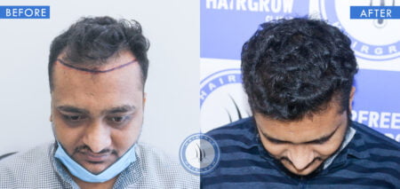 top view of before and after male hair implants treatment done at best hair transplant clinic in india hairfree and hairgrow clinic