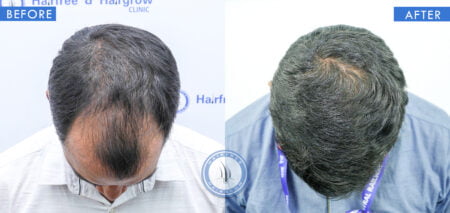 top view of before and after beginning male hair loss treatment done at best hair transplant clinic in india hairfree and hairgrow clinic