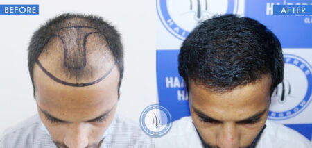 top view of before and after best hair loss treatment for male done at best hair transplant clinic in india hairfree and hairgrow clinic