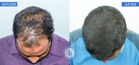 top view of before and after male pattern baldness treatments done at best hair transplant clinic in india hairfree and hairgrow clinic