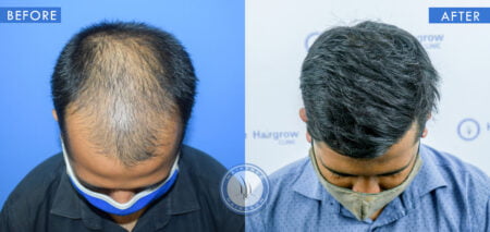 top view of before and after mens hair transplant treatment done at best hair transplant clinic in india hairfree and hairgrow clinic