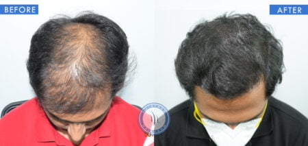 top view of before and after male hair transplant treatment done at best hair transplant clinic in india hairfree and hairgrow clinic