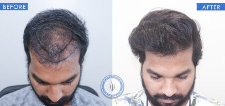 top view of before and after male hair implants treatment done at best hair transplant clinic in india hairfree and hairgrow clinic