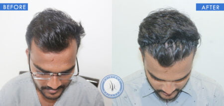 top view of before and after bald hair man treatment done at best hair transplant clinic in india hairfree and hairgrow clinic
