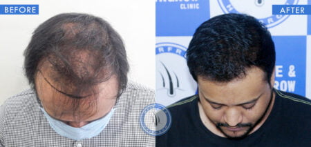Top view of before and after male hair transplant results for treatment done at best hair transplant clinic in india hairfree and hairgrow clinic