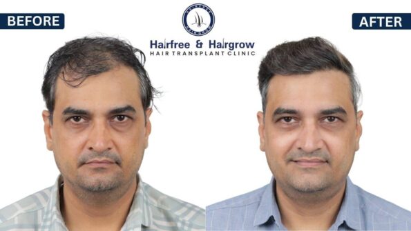 Before after hair transplant result
