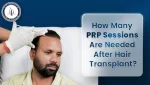 PRP sessions after hair transplant