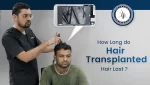 How long do transplanted hair last