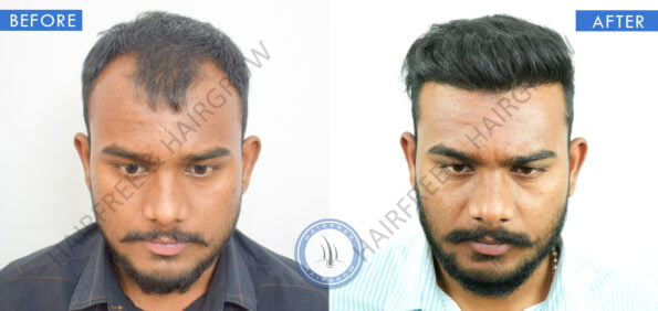 before after hairtransplant