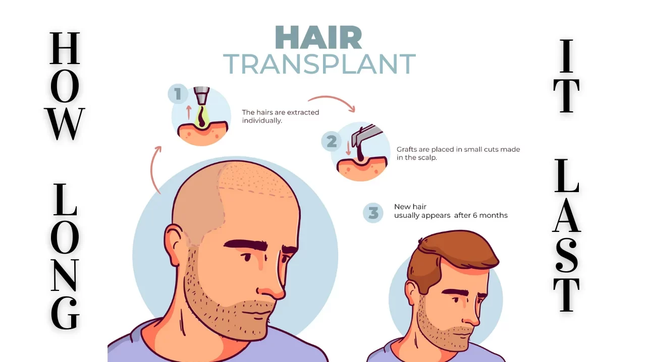 a illustration on how long does a hair transplant last
