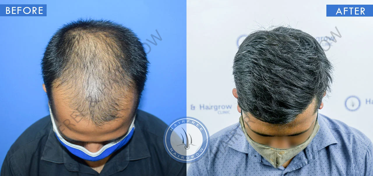 amazing-hair-transplant-result