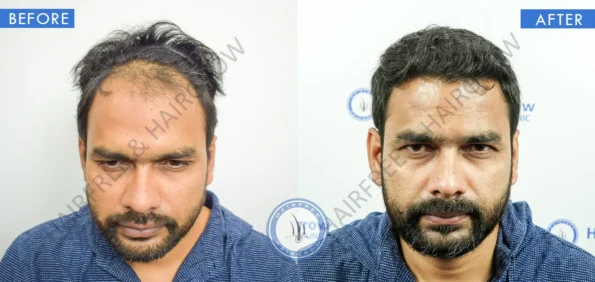 best hair transplant front