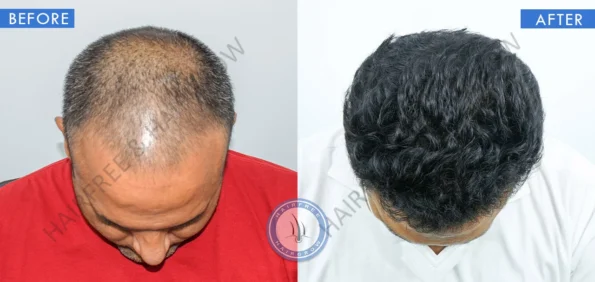 hair transplant best result 1