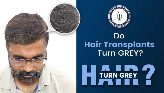 patient showing concern over hair transplant turning grey