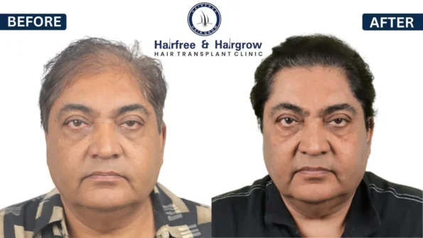 Hair Transplant Donor Area Result