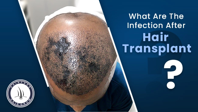 patient being treated after he is having infections after hair transplant