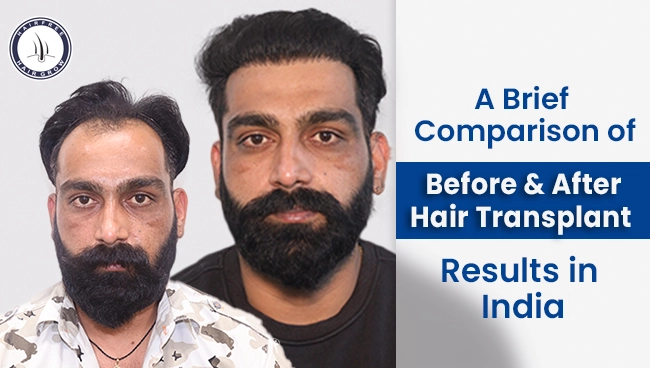 Before and After Hair Transplant Results showing hair growth transformation