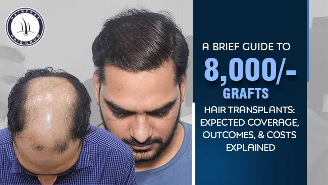 Visual representation of 8000 Grafts Hair Transplants before and after