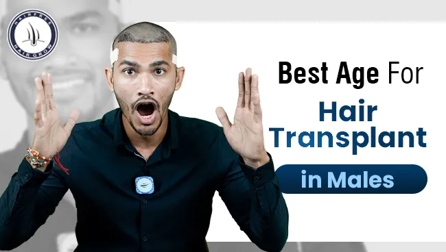 Best Age for Hair Transplant in Males, highlighting the most common age range of 30-39 years