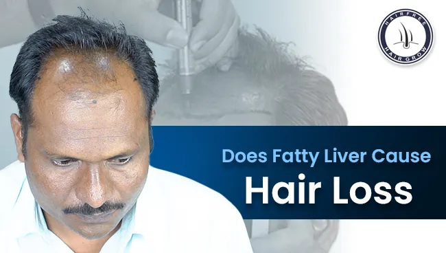 connection between fatty liver and hair loss, depicting liver and thinning hair