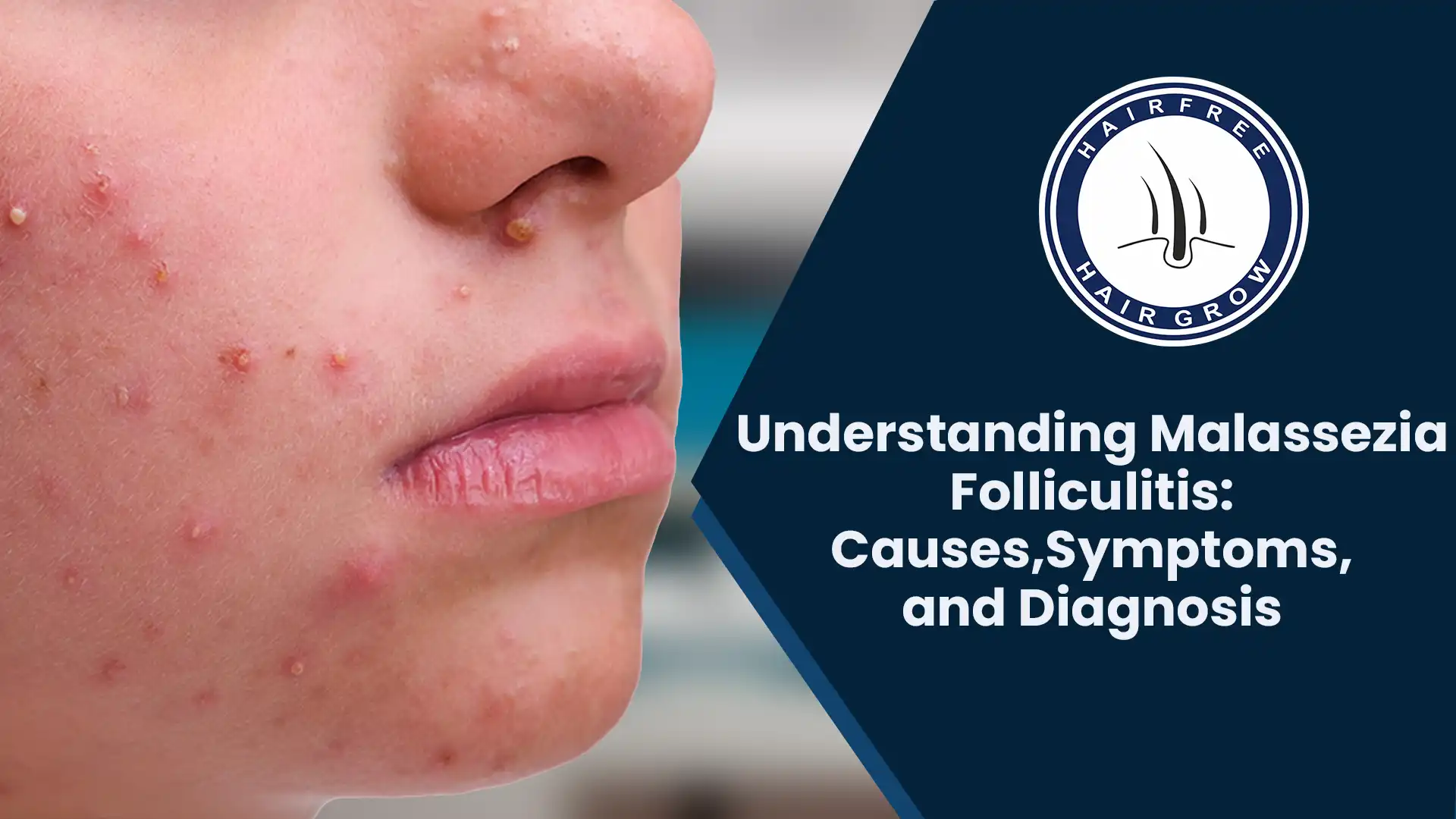 Skin affected by Malassezia Folliculitis