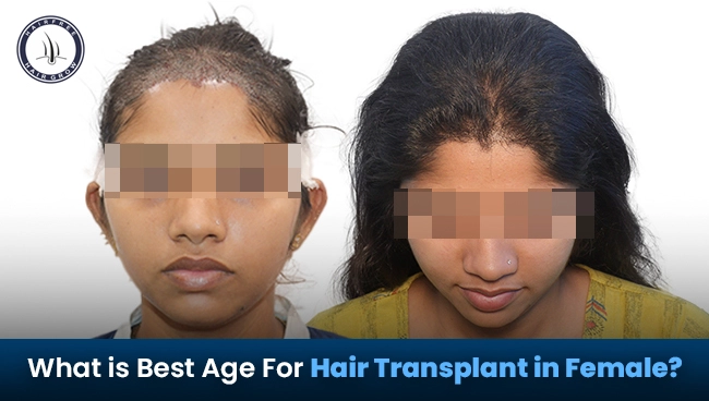 showing the best age for hair transplant in female patients