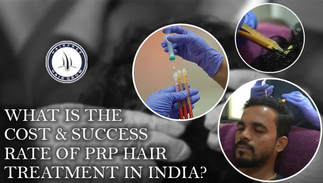 Cost and success rate of PRP hair treatment explained with results