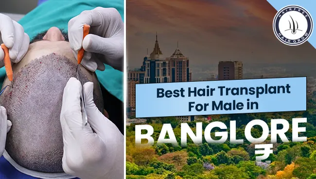 Overview of Best Hair Transplant For Male in Bangalore options