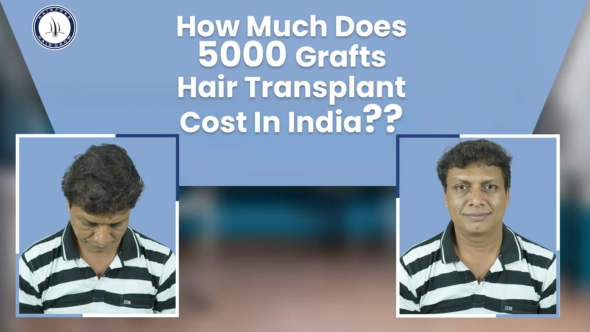 Affordable 5000 Grafts Hair Transplant Cost for Full Hair Restoration