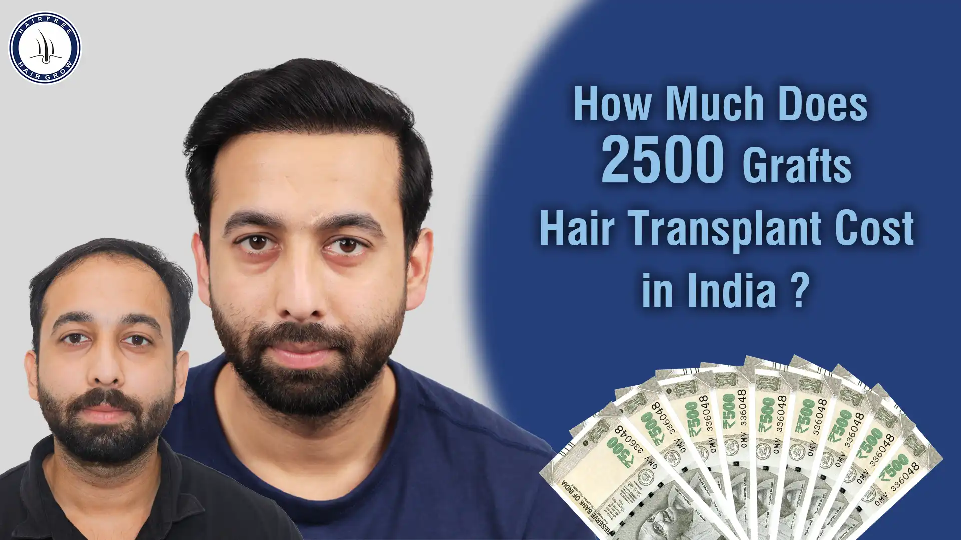 2500 grafts hair transplant cost in India and factors affecting pricing for hair restoration treatments