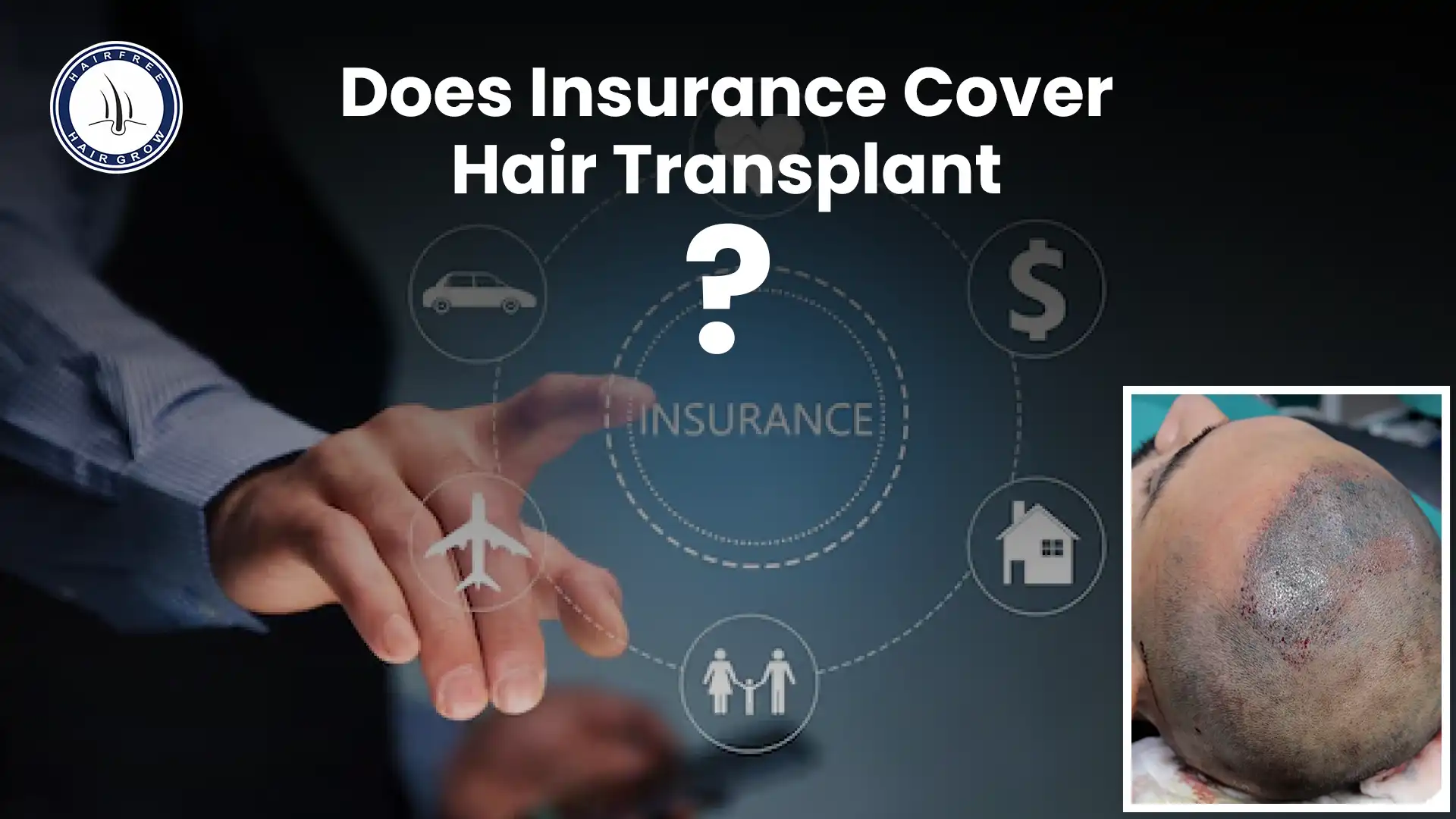 Does Insurance Cover Hair Transplants and What to Know.