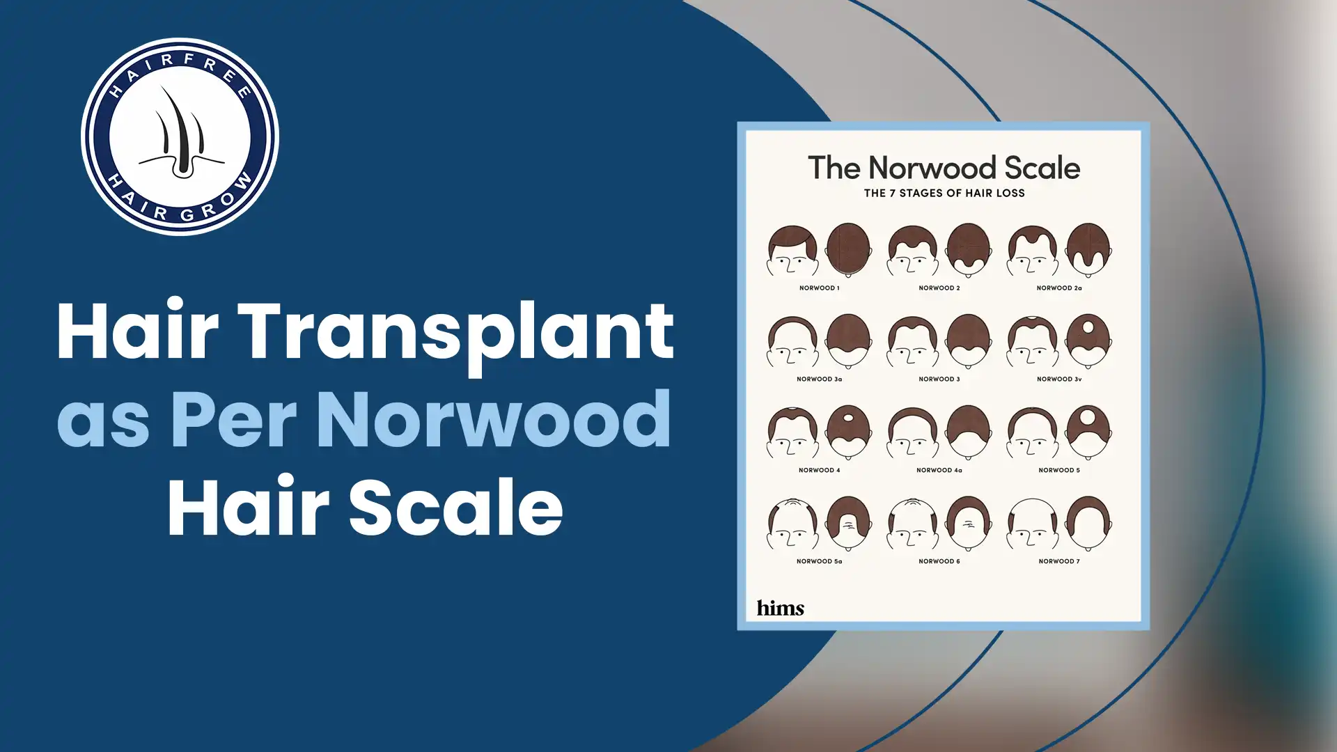 Illustration of the Norwood Hair Scale, showing stages of male pattern baldness for hair loss assessment