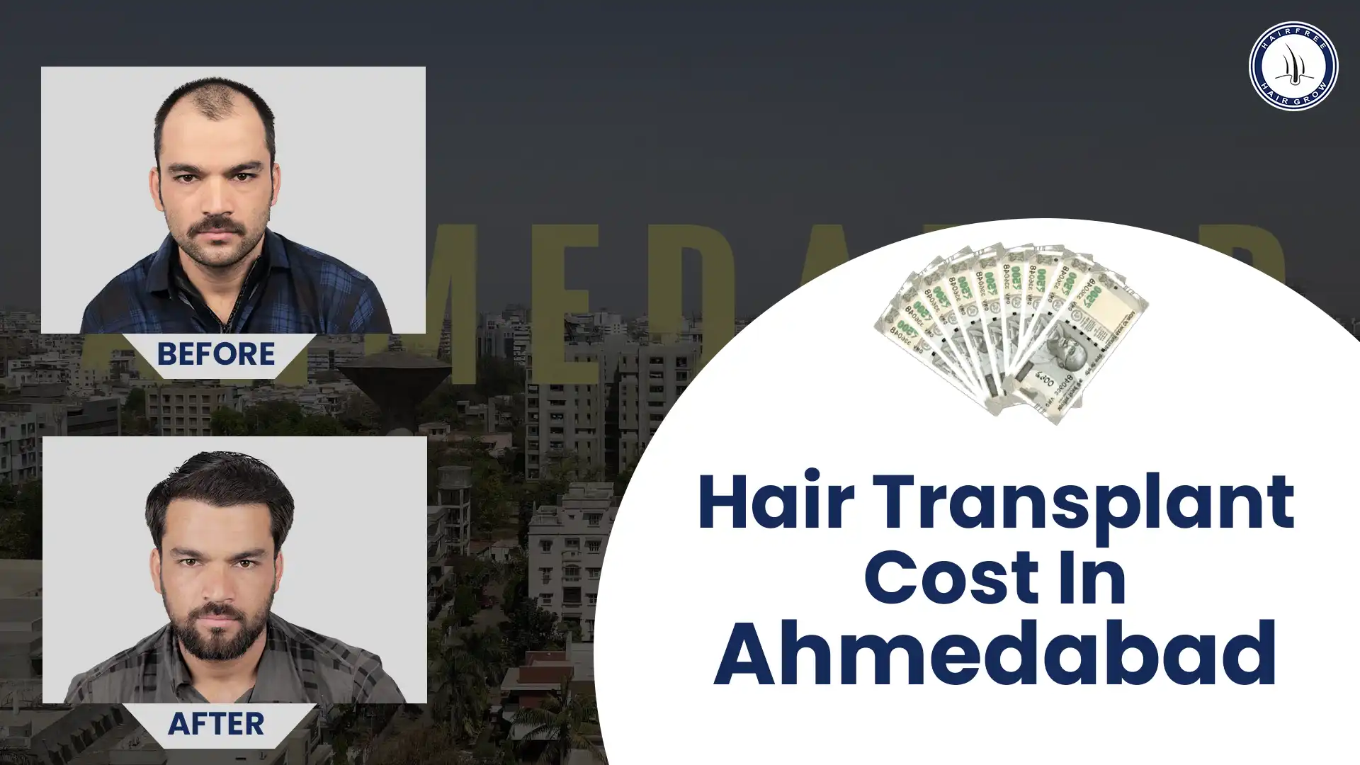 Understanding Hair Transplant Cost in Ahmedabad for Best Results