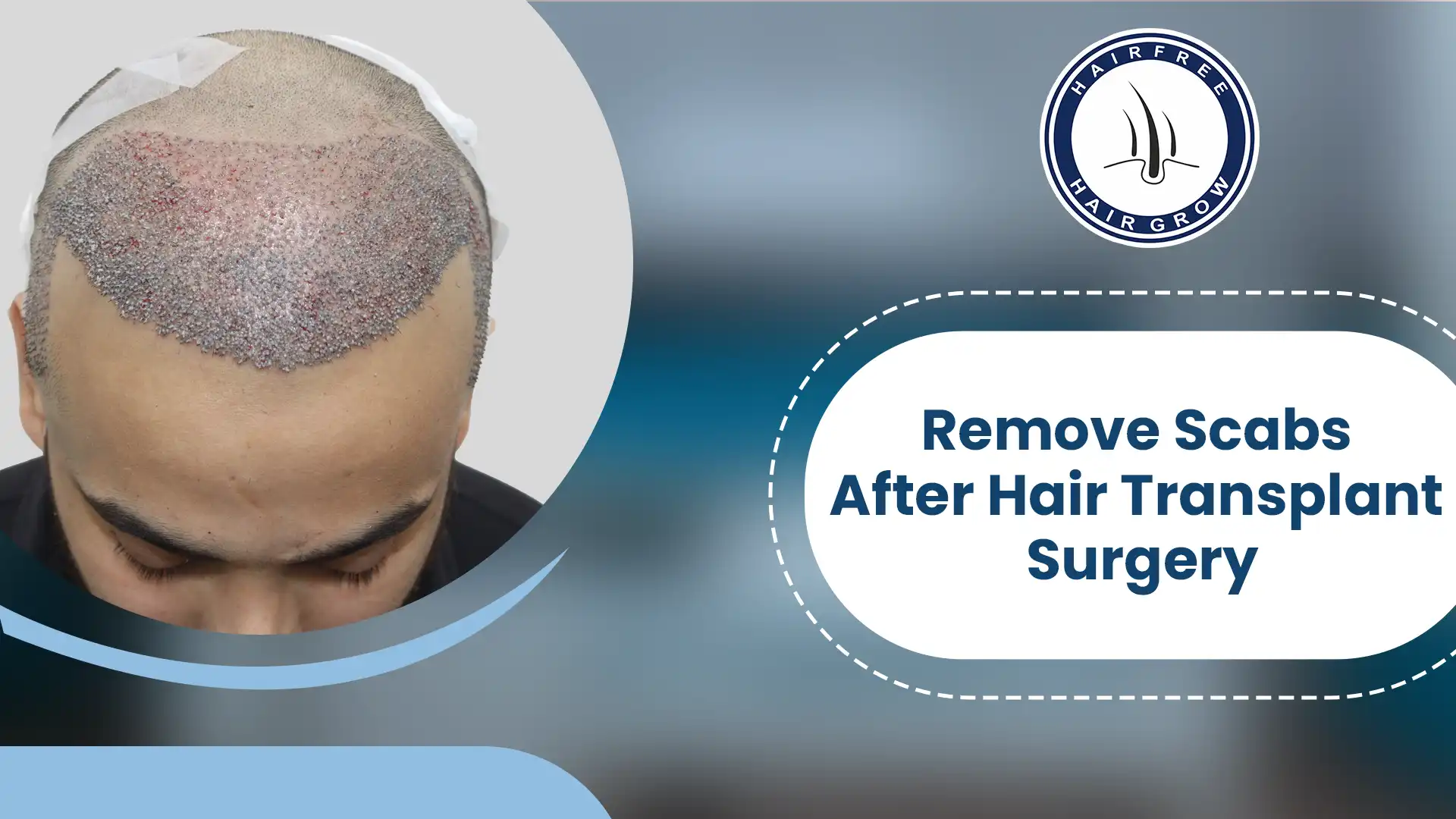 Guide on how to safely remove scabs after hair transplant for optimal recovery.