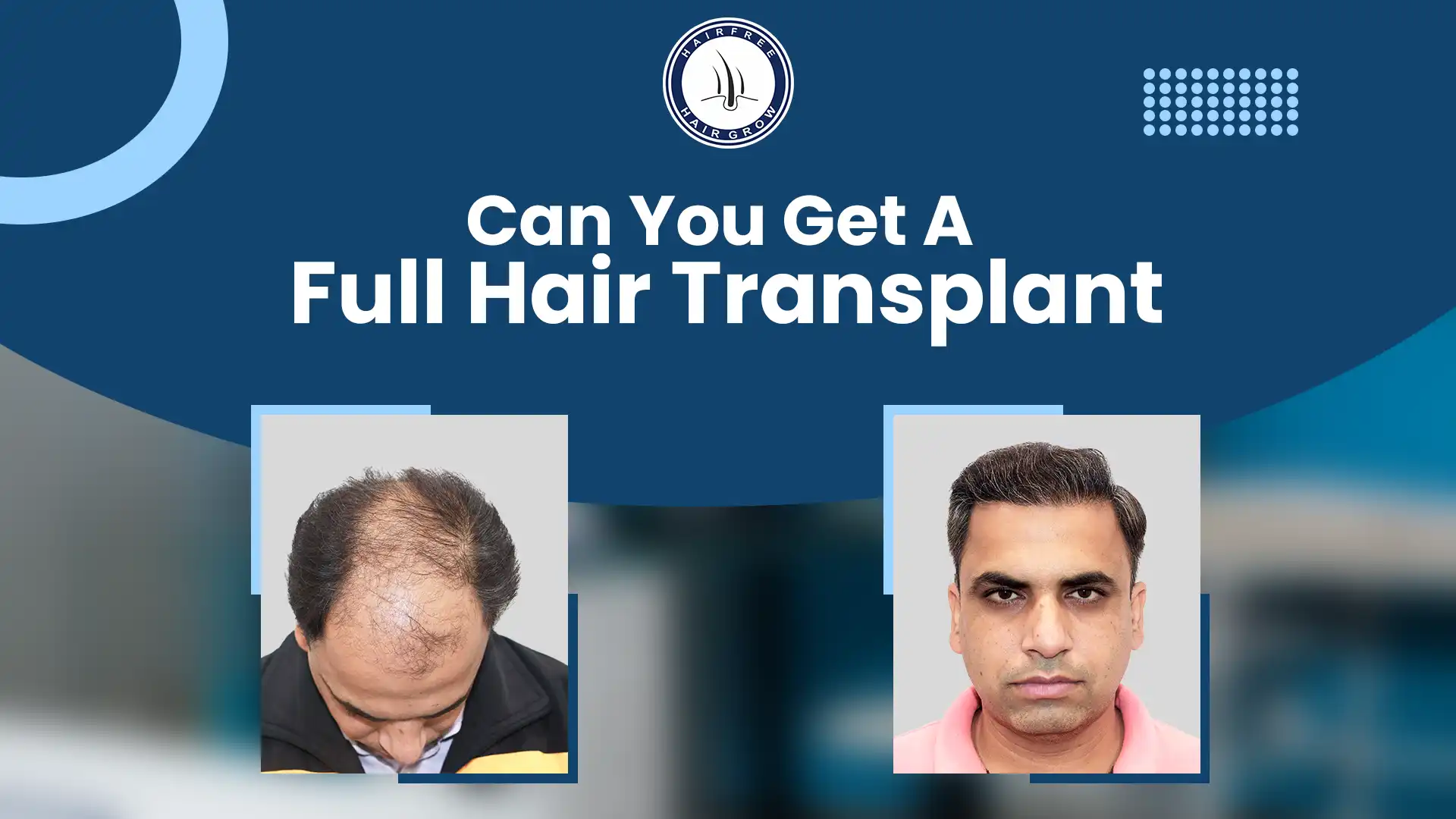 Achieve Natural Results with a Full Hair Transplant Solution