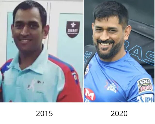 MS Dhoni Hair Transplant Case Study