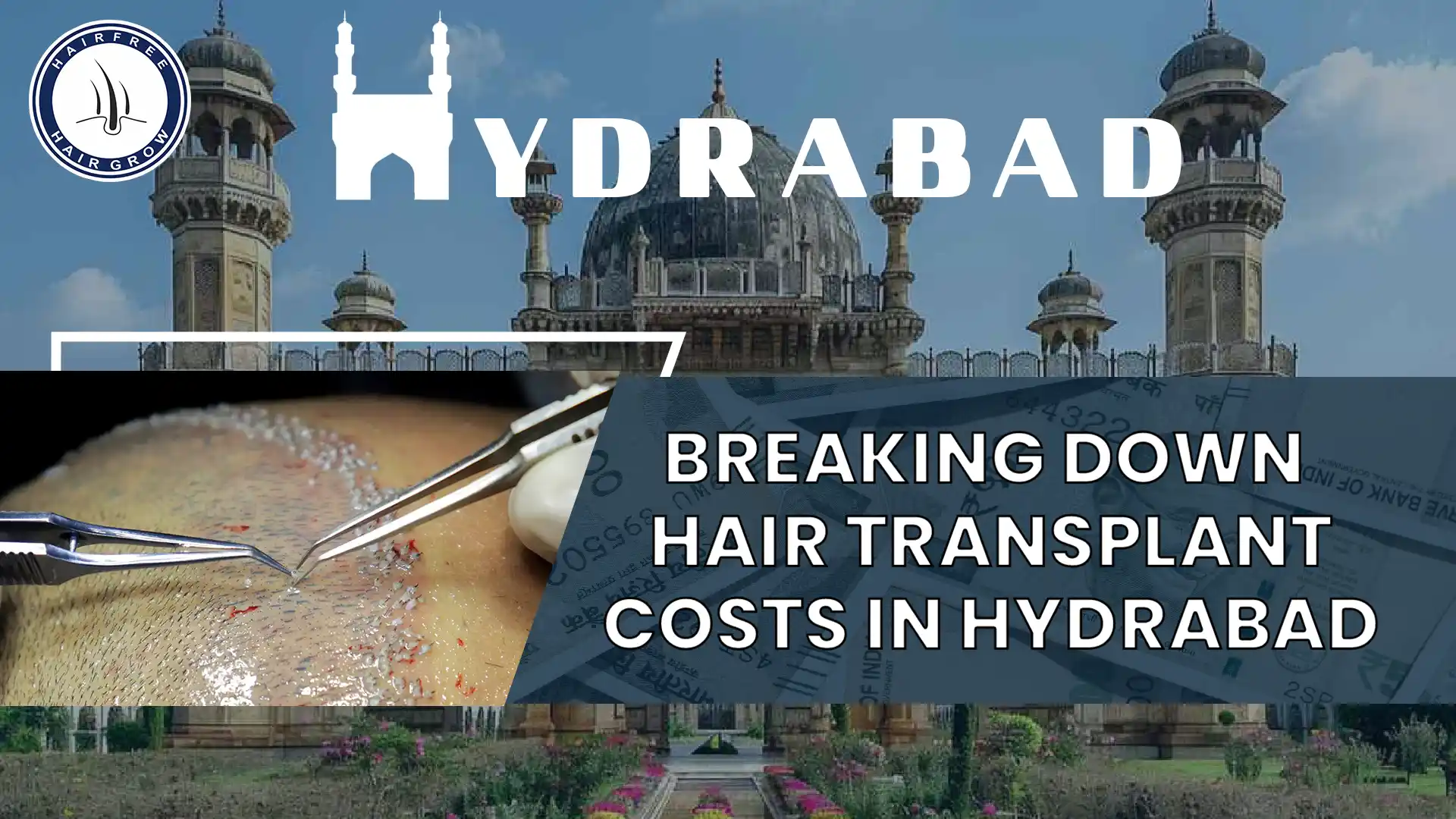 Hair Transplant Cost in Hyderabad: Detailed Insights and Pricing Guide