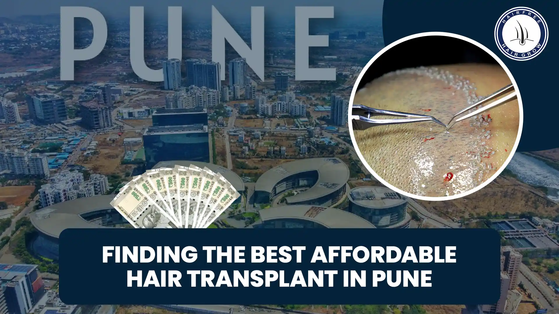 Guide to Finding Affordable Hair Transplant in Pune for Cost-Effective Solutions