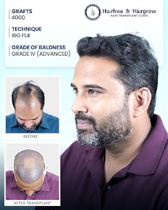 Grade 4 baldness