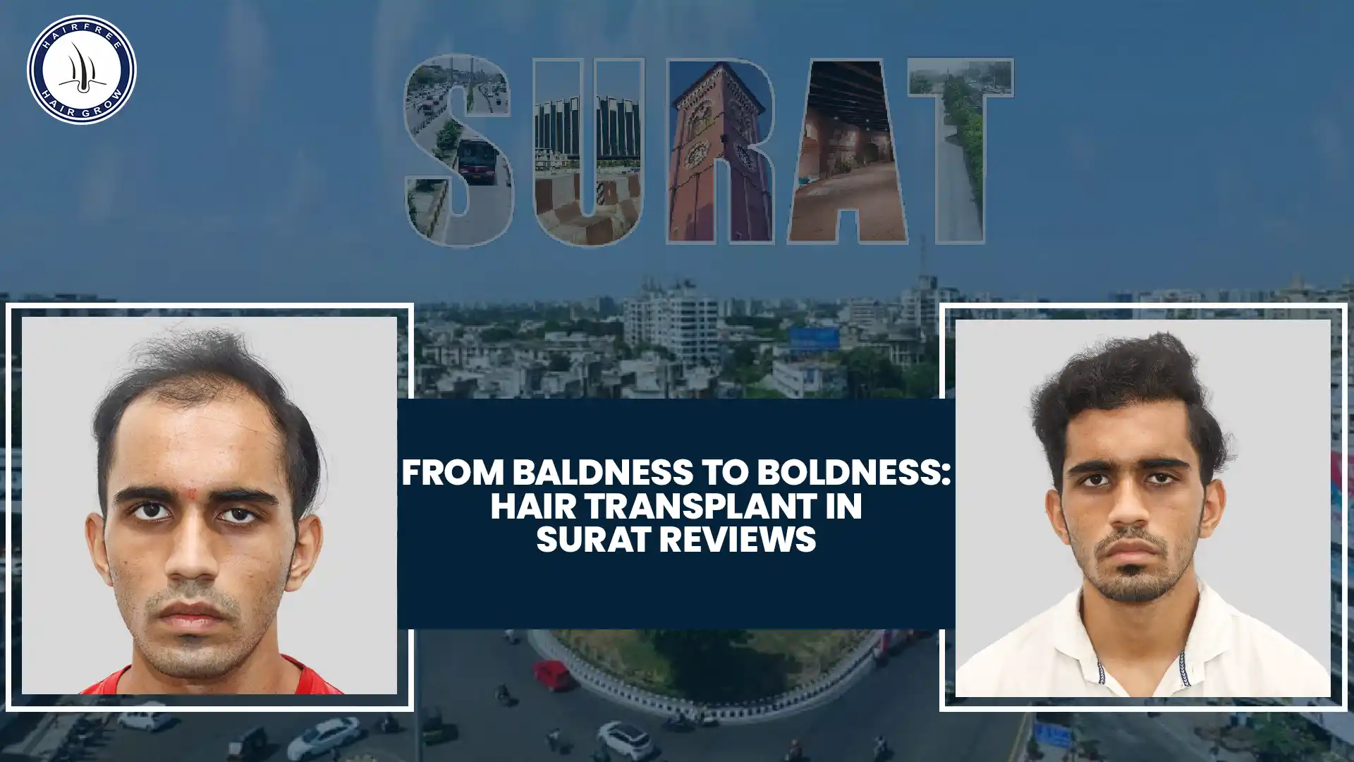 Before and after results of Hair Transplant in Surat Reviews with visible improvement