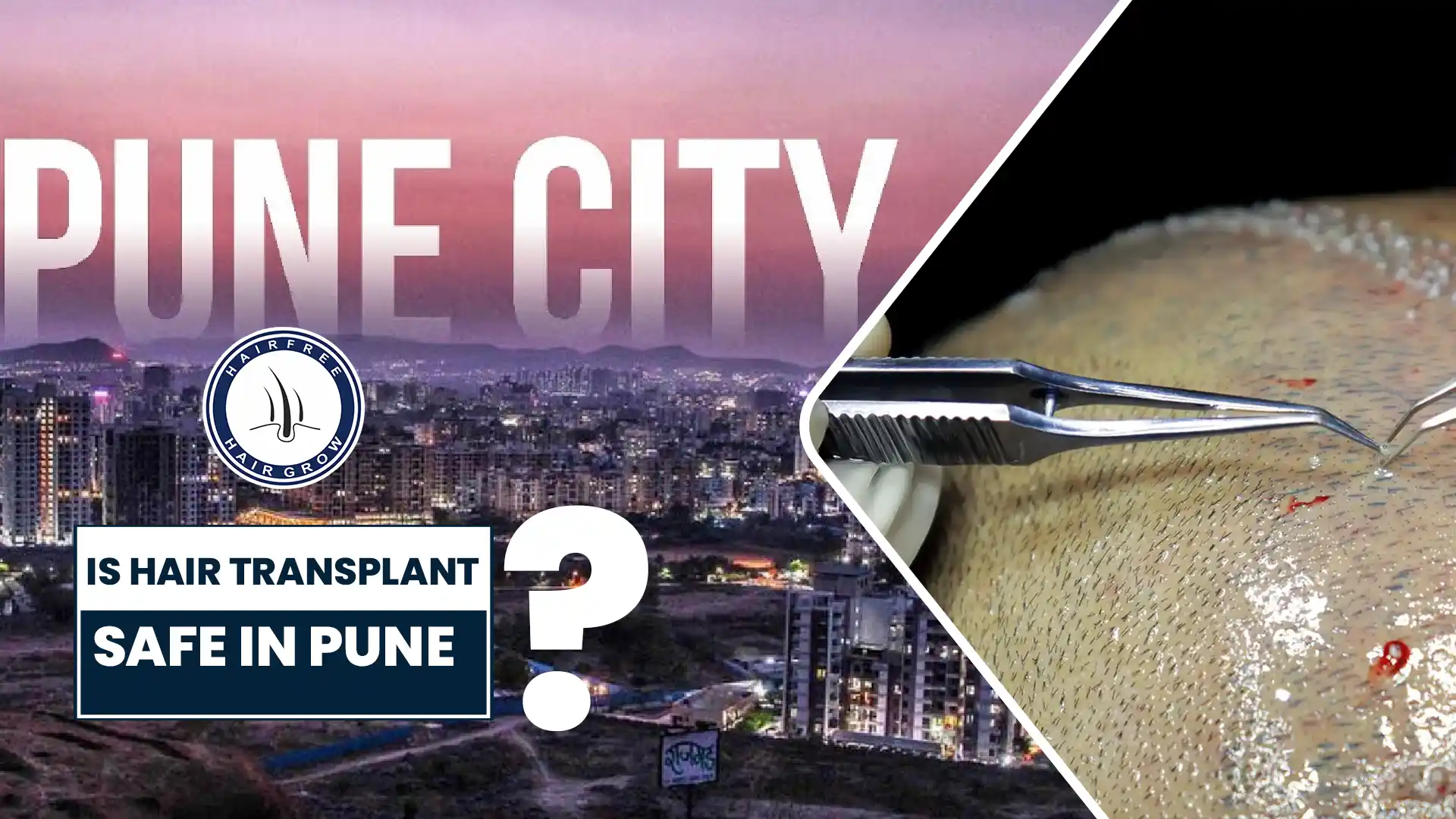 Is Hair Transplant Safe in Pune? Exploring Safety and Expertise