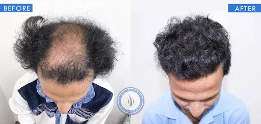 hair transplant patient results 5