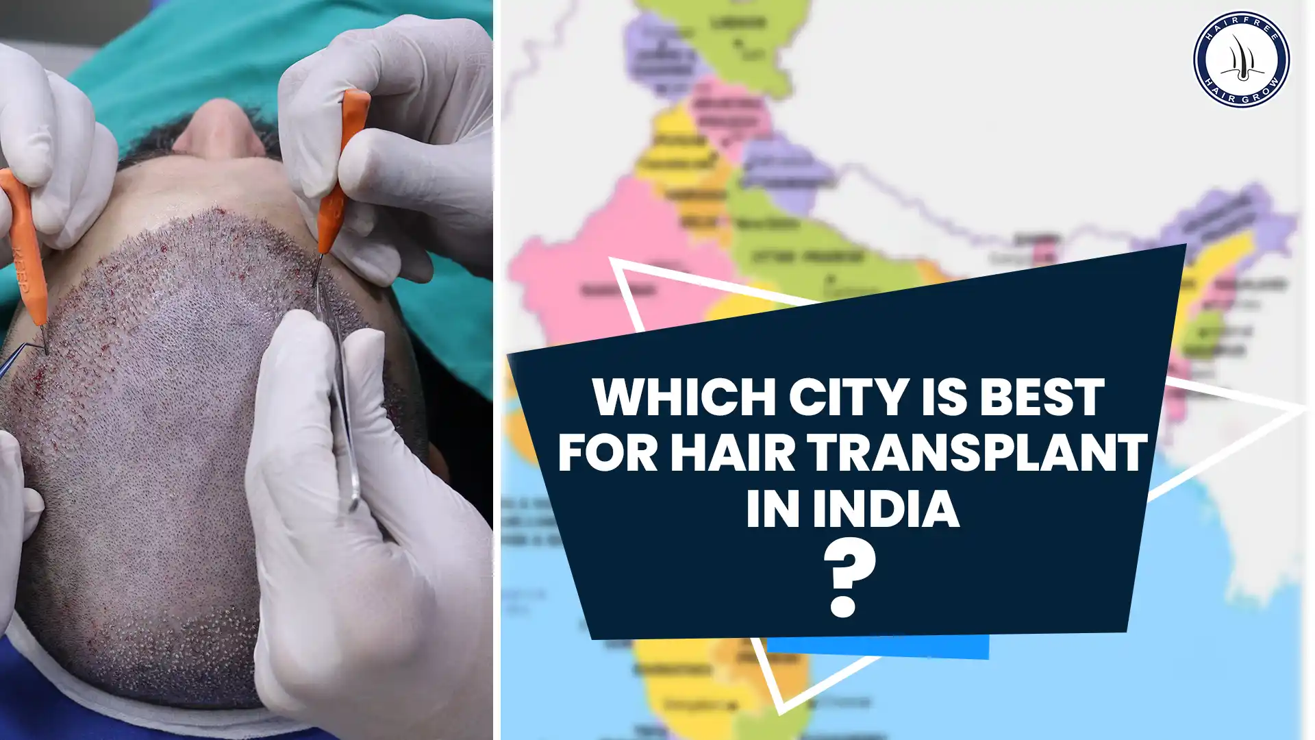 Which City is Best for Hair Transplant in India: A Guide to Top Locations