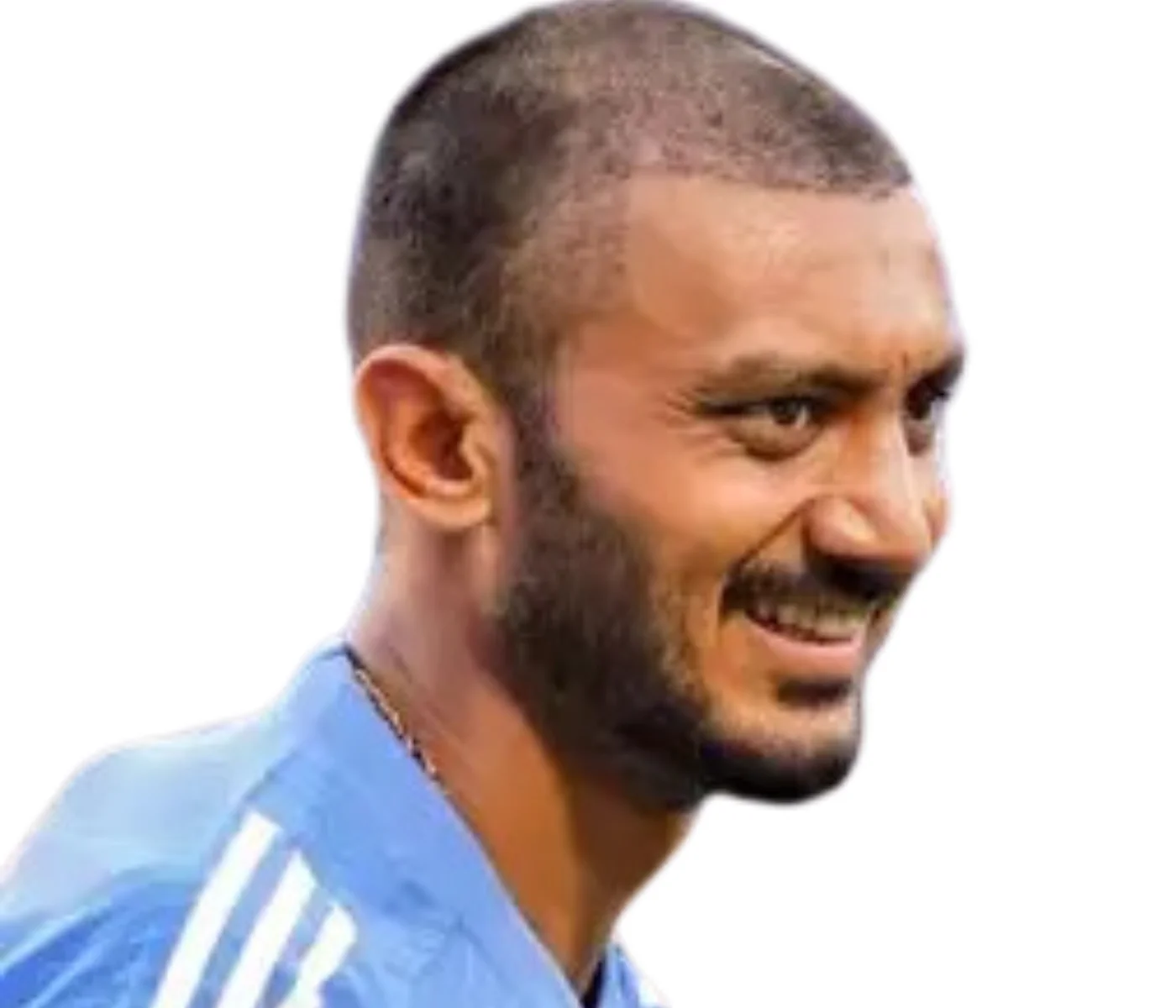 Axar Patel Hair Transplant Result