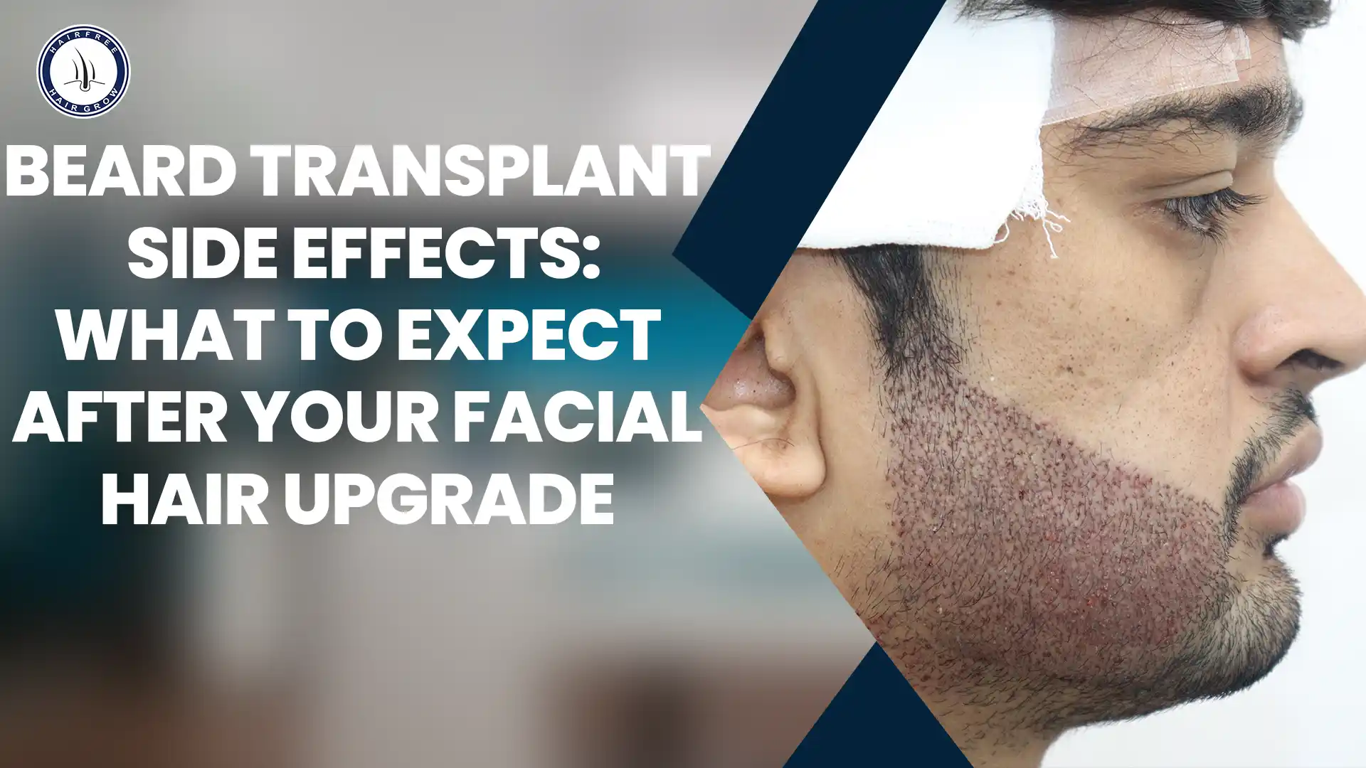 Beard Transplant Side Effects include redness, swelling, and temporary discomfort.