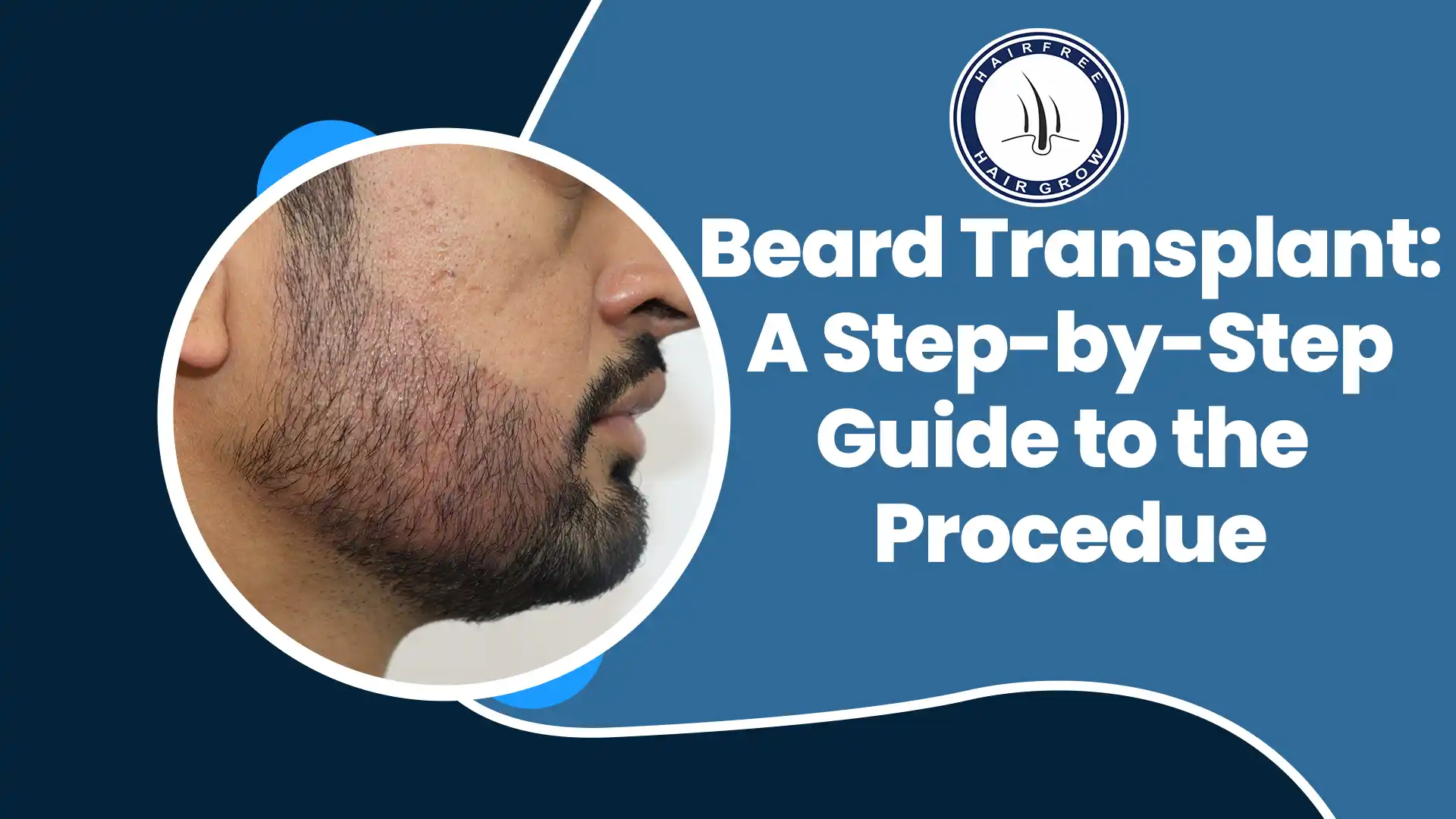 Beard Transplants help achieve fuller facial hair with a step-by-step procedure