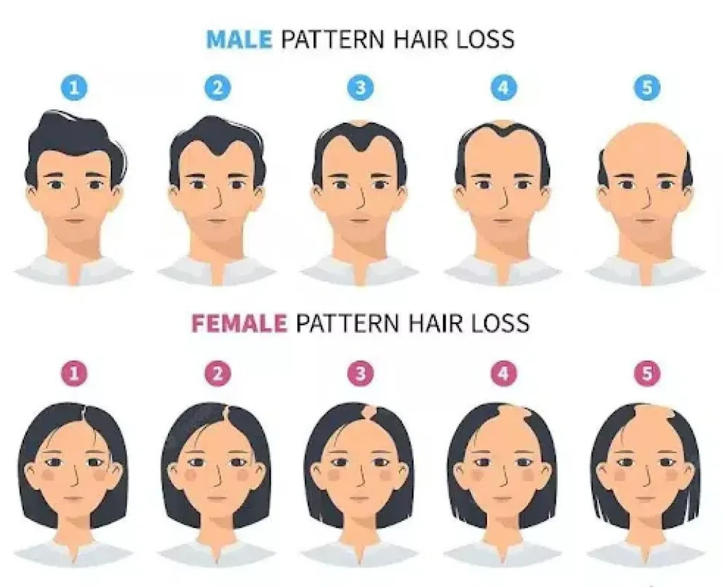 Difference Between Hair Transplants in Men and Women