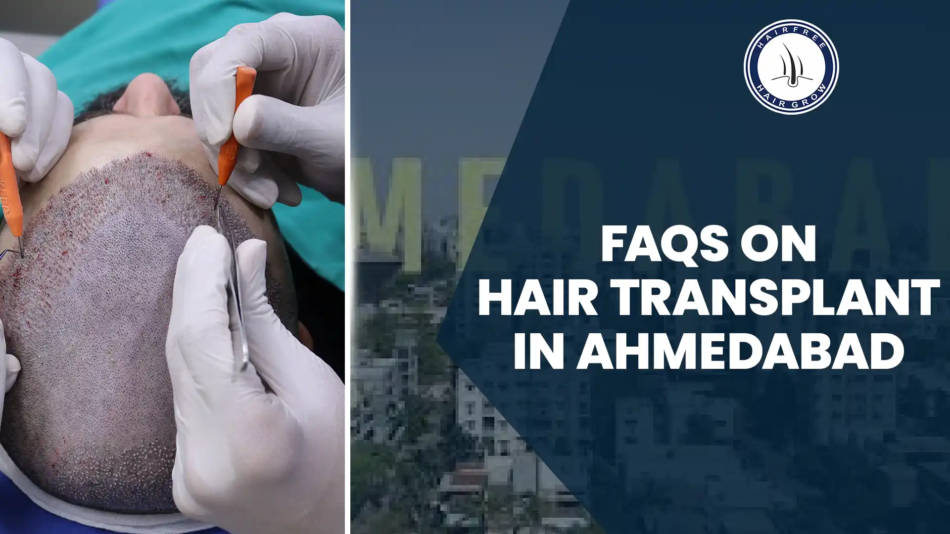 Top FAQs About Hair Transplant in Ahmedabad: Expert Answers and Guidance