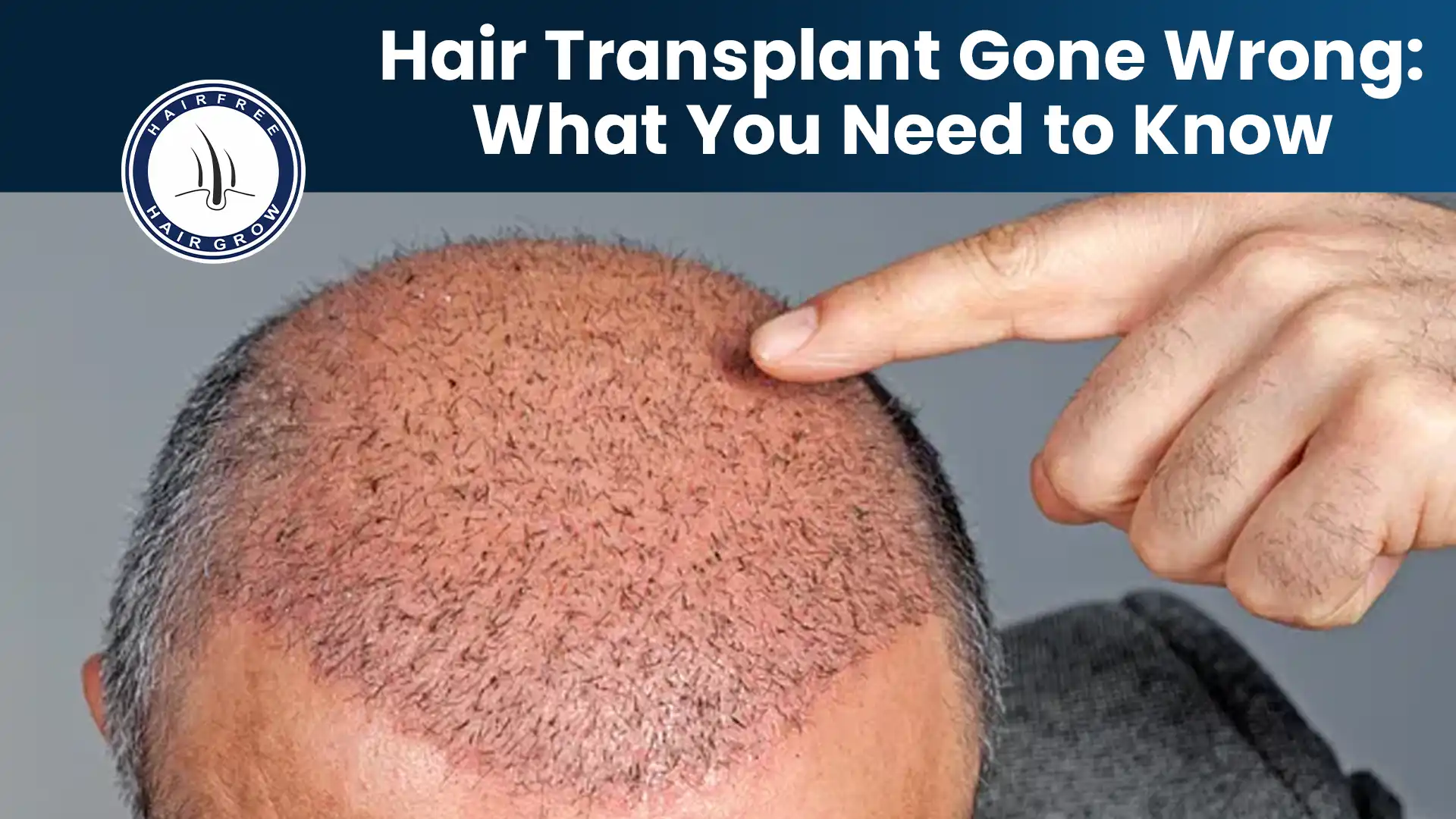 Scalp with redness and uneven hair growth after Hair Transplant Gone Wrong